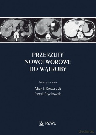 Przerzuty nowotworowe do wątroby [KSIĄŻKA]