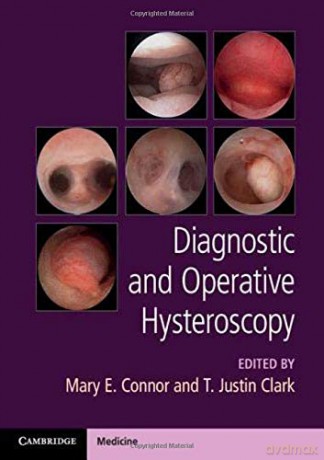 Diagnostic and Operative Hysteroscopy - Mary E. Connor [KSIĄŻKA]