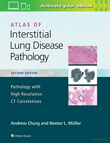 Atlas of Interstitial Lung Disease Pathology - Andrew Churg [KSIĄŻKA]