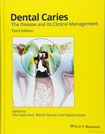 Dental Caries: The Disease and its Clinical Management - Bente Nyvad [KSIĄŻKA]