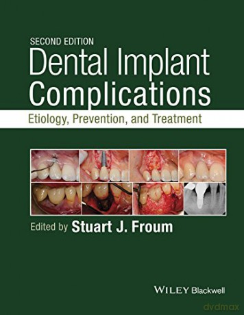 Dental Implant Complications: Etiology, Prevention, and Treatment - Stuart J. Froum [KSIĄŻKA]