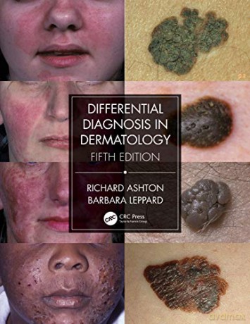 Differential Diagnosis in Dermatology - Richard Ashton [KSIĄŻKA]