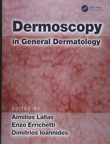 Dermoscopy in General Dermatology - Aimilios Lallas [KSIĄŻKA]