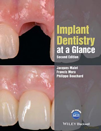 Implant Dentistry at a Glance, 2nd Edition At a Glance Dentistry - Jacques Malet [KSIĄŻKA]