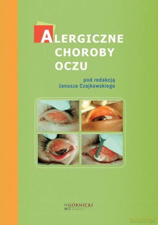 Alergiczne choroby oczu - Ewa Bogacka, Janusz Czajkowski [KSIĄŻKA]