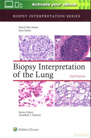 Biopsy Interpretation of the Lung Second edition - Saul Suster, David Suster [KSIĄŻKA]
