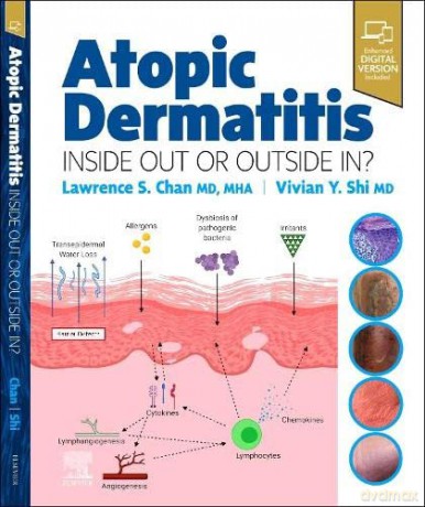 Atopic Dermatitis: Inside Out or Outside In - Lawrence S Chan MD. MHA [KSIĄŻKA]