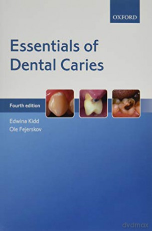Essentials of Dental Caries [KSIĄŻKA]