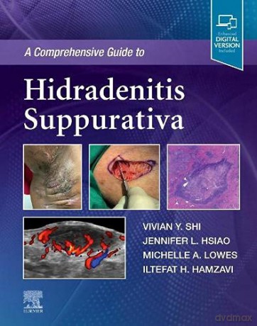 A Comprehensive Guide to Hidradenitis Suppurativa - Vivian Y. Shi MD [KSIĄŻKA]