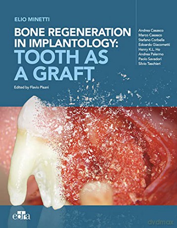 Bone regeneration in implantology: tooth as a graft - Elio Minetti [KSIĄŻKA]
