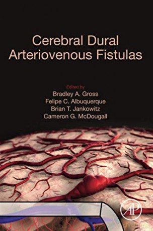 Cerebral Dural Arteriovenous Fistulas - Bradley A. Gross [KSIĄŻKA]