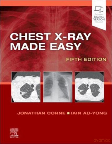 Chest X-Ray Made Easy - Jonathan Corne MA PhD MB BS FRCP [KSIĄŻKA]