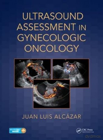 Ultrasound Assessment in Gynecologic Oncology - Juan Luis Alcázar [KSIĄŻKA]