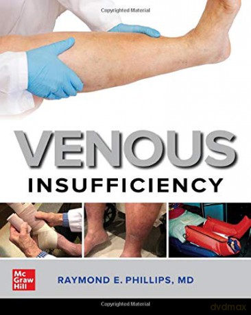 Venous Insufficiency (INTERNAL MEDICINE) - Raymond E. Phillips [KSIĄŻKA]