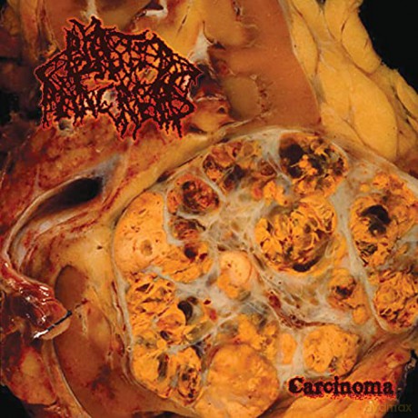 Blasted Pancreas: Carcinoma [CD]