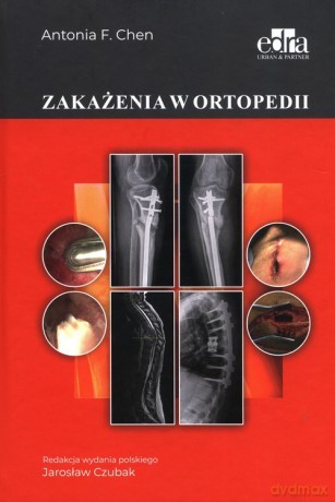 Zakażenia w ortopedii - A.F. Chen [KSIĄŻKA]