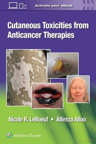 Cutaneous Reactions from Anti-Cancer Therapies [KSIĄŻKA]