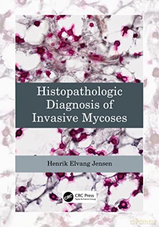 Histopathologic Diagnosis Of Invasive My - Henrik Elvan Jensen [KSIĄŻKA]