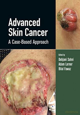 Advanced Skin Cancer [KSIĄŻKA]