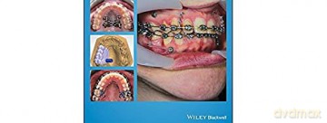 Orthodontic Miniimplant Clinical Handboo - Richard Cousley [KSIĄŻKA]