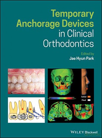 Temporary Anchorage Devices In Clinical - Jae Hyun Park [KSIĄŻKA]