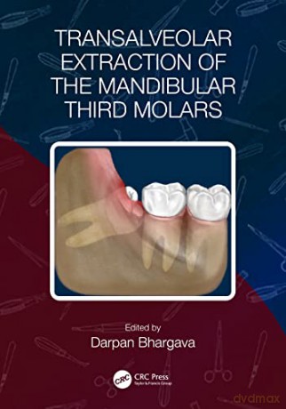 Transalveolar Extraction Of The Mandibul - Darpan Bhargava [KSIĄŻKA]