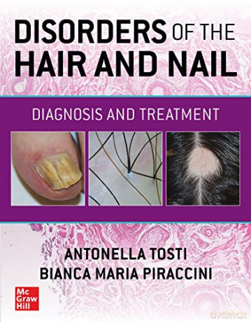 Disorders of the Hair and Nail: Diagnosis and Treatment - Tosti [KSIĄŻKA]