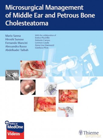 Microsurgical Management of Middle Ear and Petrous Bone Cholesteatoma - Mario Sanna [KSIĄŻKA]