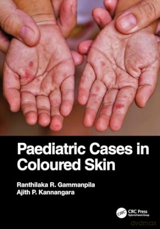 Paediatric Cases In Coloured Skin - Ranthila Gammanpila [KSIĄŻKA]