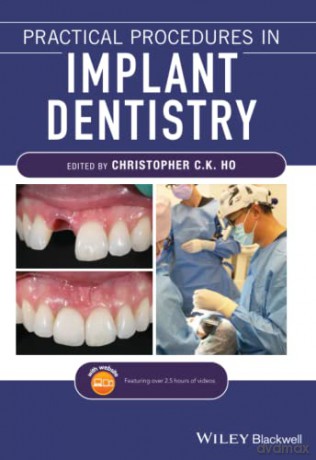 Practical Procedures in Implant Dentistry - Christopher C. K Ho [KSIĄŻKA]