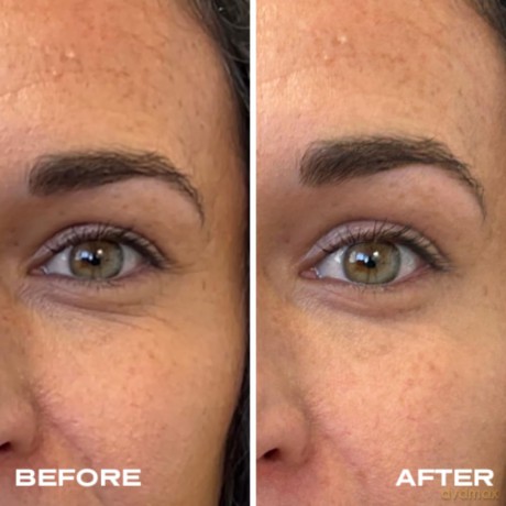 Plump It! - No Needles Dermal Filler Transparent 15 x 0,67 ml