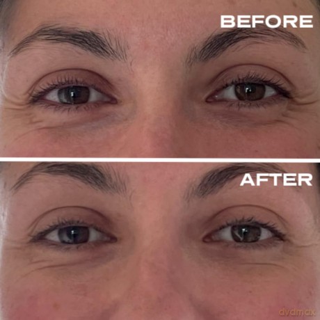 Plump It! - No Needles Dermal Filler Transparent 15 x 0,67 ml