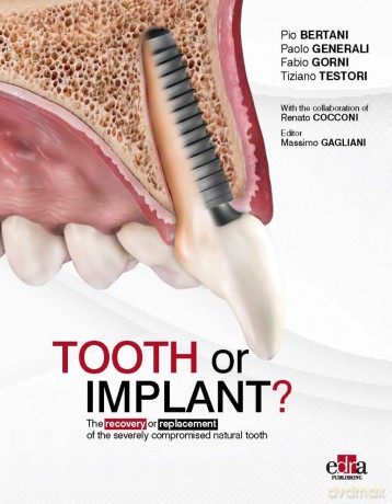 Tooth or Implant - Paolo Generali [KSIĄŻKA]