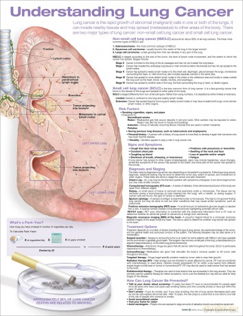 Understanding Lung Cancer Anatomical Chart Laminated - Anatomical Chart Company [KSIĄŻKA]