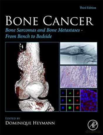 Bone Cancer: Bone Sarcomas and Bone Metastases - From Bench to Bedside - Dominique Heymann [KSIĄŻKA]