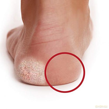 Peter Bausch 0328 - Aufladbares Hornhautschleifgerät EasyPedipeel mit ergonomischem Griff zum Entfernen von Hornhaut