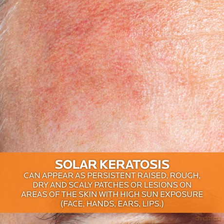 La Roche Posay Face sunscreen SPF 50 Anthelios 100 KA+ MED (Cream) 50 ml dla kobiety