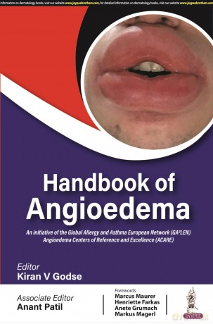 Handbook of Angioedema - Kiran V Godse [KSIĄŻKA]