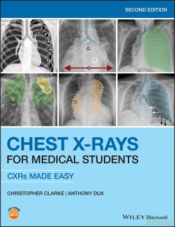 Chest X-Rays for Medical Students: CXRs Made Easy, 2nd Edition - Christopher Clarke [KSIĄŻKA]