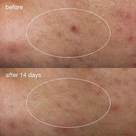 Anti-acne serum Deep Acne Liquid Patch 15 ml