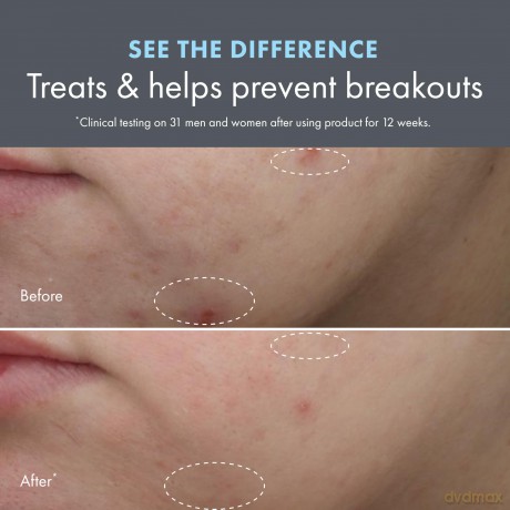 Clear Improvement Blemish Clearing Hydrating Lotion 50 ml