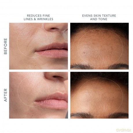 KIWI Derma Microdermabrasion device for cleansing and renewing the skin