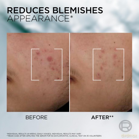 Men Expert Derma Control Anti-Blemish Serum Niacinamide Anti-Blemish Serum 30 ml