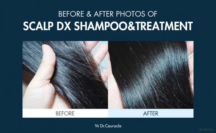 Shampoo against hair loss Scalp DX Scaling Shampoo - Volume: 500 ml