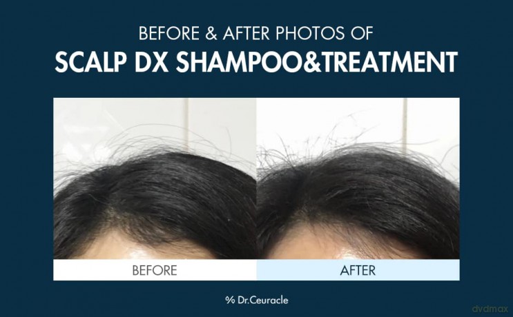 Shampoo against hair loss Scalp DX Scaling Shampoo - Volume: 500 ml