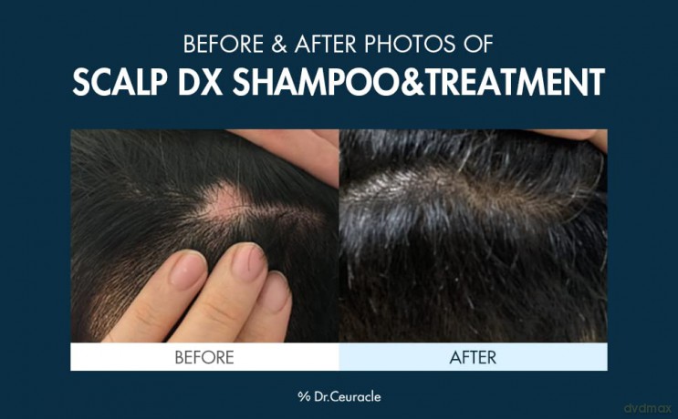 Shampoo against hair loss Scalp DX Scaling Shampoo - Volume: 500 ml