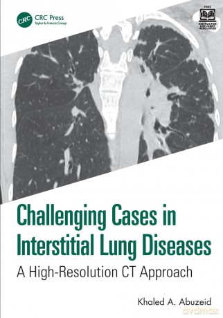 Challenging Cases in Interstitial Lung Diseases: A High-Resolution CT Approach - Khaled A. Abuzeid [KSIĄŻKA]