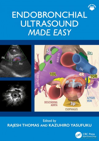 Endobronchial Ultrasound Made Easy: Made Easy - Rajesh Thomas [KSIĄŻKA]