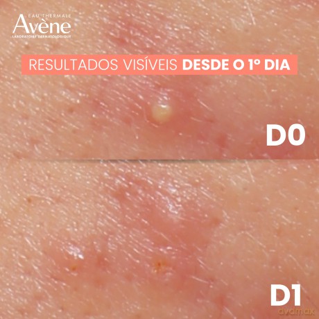 Avene Intensive cream for aggravated acne Cleanance Comedomed Peeling (Intensive Spot Breakout Cream) 40 ml