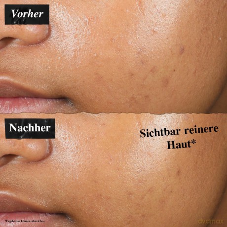 Kiehl's Invisible liquid acne patch (Truly Targeted Blemish-Clearing Solution) 15 ml